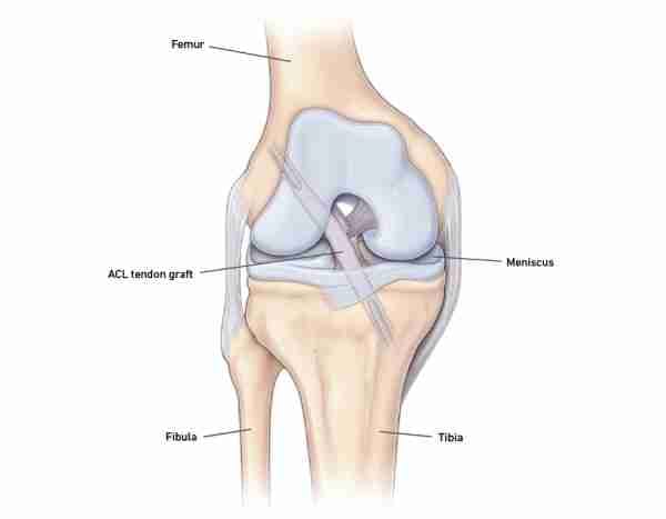 Illustration of a knee after ACL reconstruction with the tendon graft, meniscus, femur, tibia, and fibula labeled.