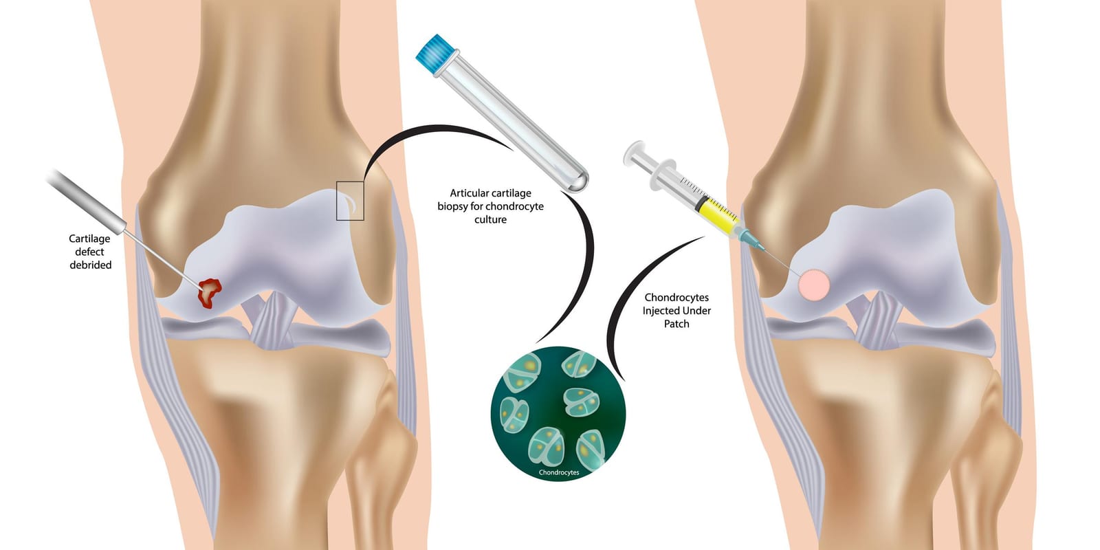 Medical illustration of autologous chondrocyte implantation showing cartilage biopsy, chondrocyte culture, and injection of cells into a knee cartilage defect.