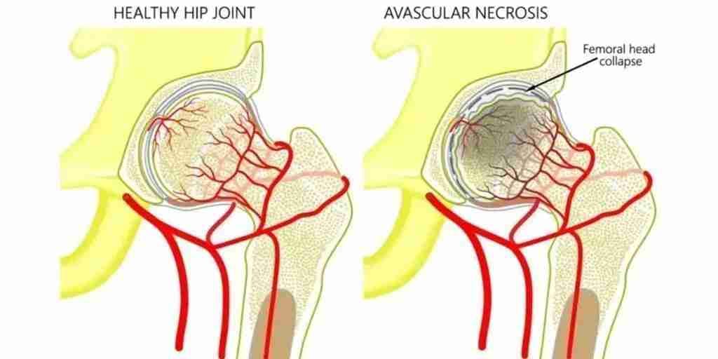 Diagram comparing a healthy hip joint with avascular necrosis and collapse of the femoral head.
