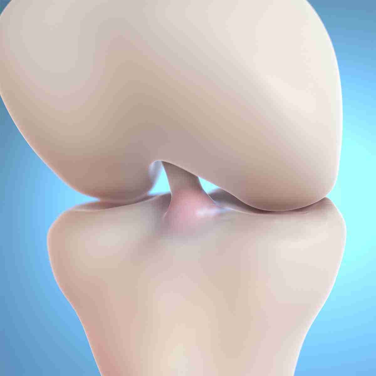 Medical illustration of a knee joint showing the ACL restored after the BEAR implant is replaced by healed tissue.