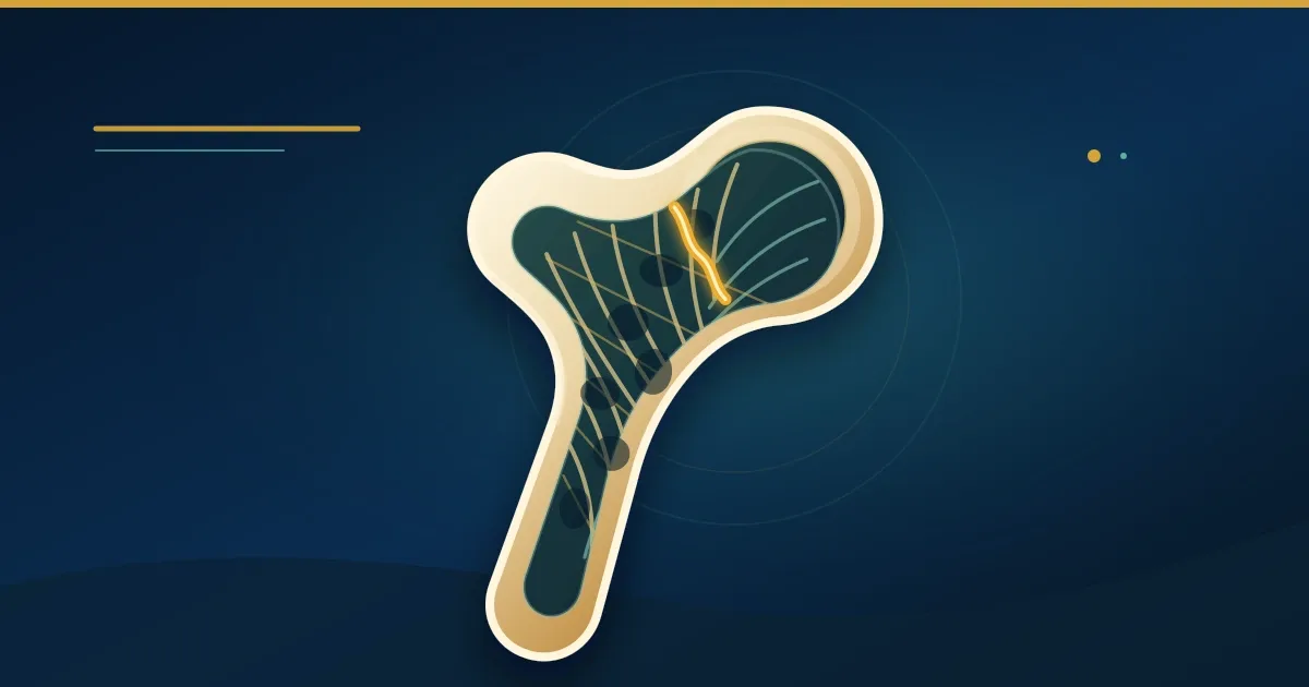 Stylized illustration of a proximal femur with a fracture line, the fragility-fracture injury pattern behind most broken hips.