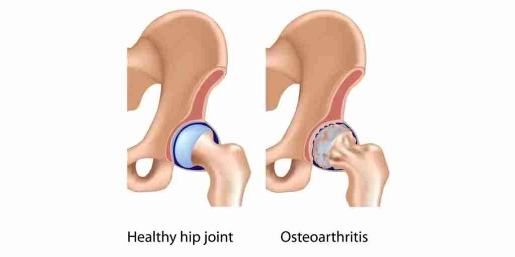 Medical illustration comparing a healthy hip joint with one damaged by osteoarthritis.
