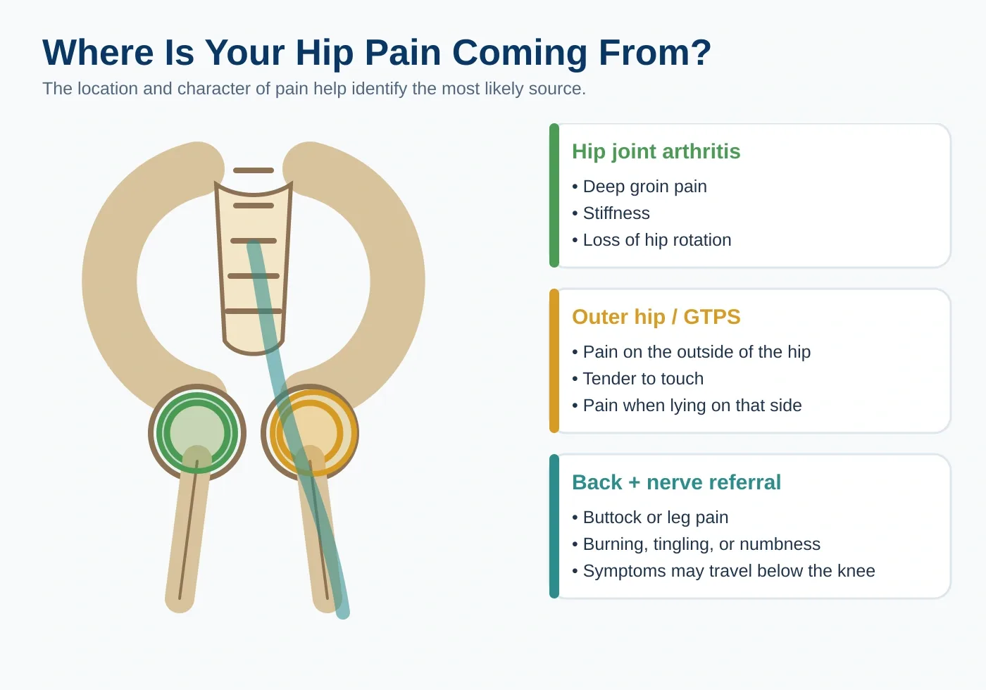 Infographic showing how hip joint arthritis, outer-hip bursitis, and referred back or nerve pain each cause hip pain in different locations.