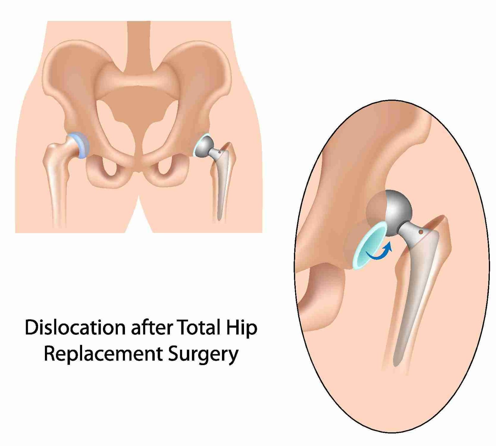 Medical illustration of a dislocated hip implant after total hip replacement, with a close-up showing the ball out of the socket.