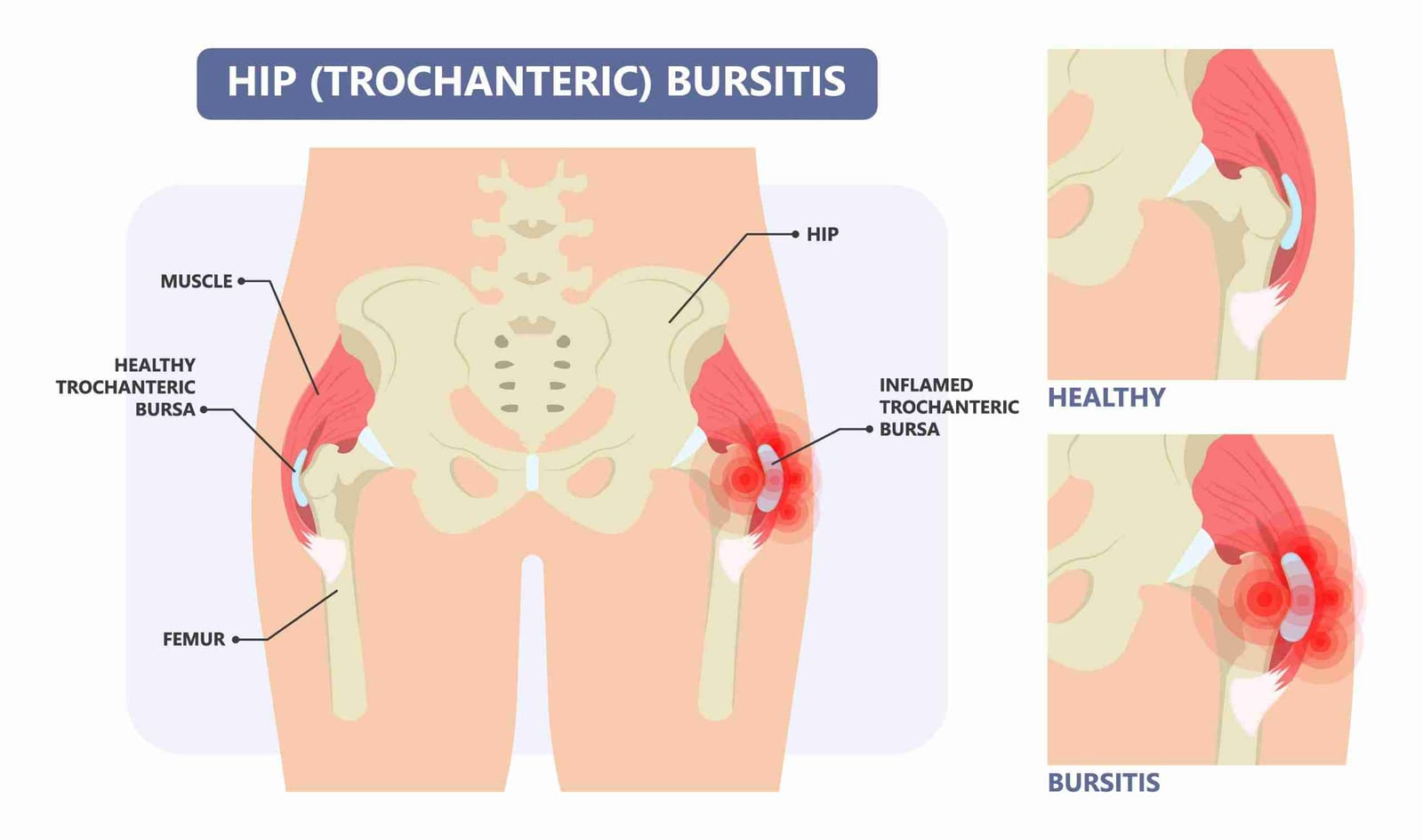 Labeled diagram of trochanteric bursitis comparing a healthy hip bursa with an inflamed one.