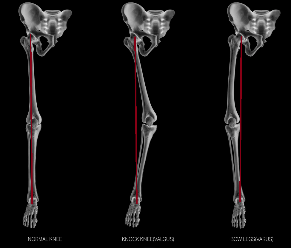 Skeletal diagram comparing normal knee alignment with knock knees (valgus) and bow legs (varus).