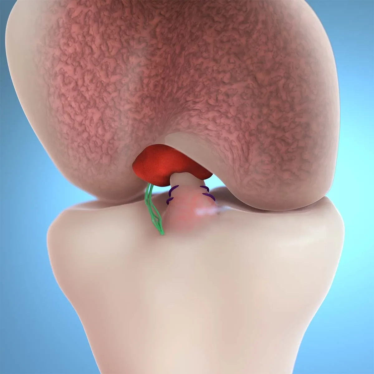 3D illustration of a knee cartilage repair step showing sutures securing tissue within the joint.