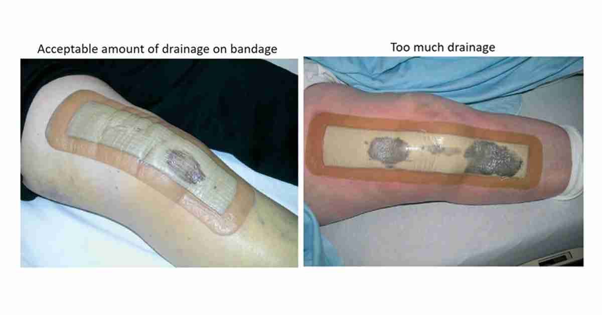 Side-by-side photos comparing an acceptable amount of incision drainage on a knee bandage with excessive drainage.