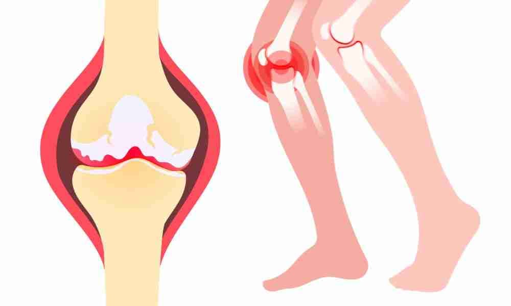 Illustration of an arthritic knee joint with worn cartilage and inflammation beside a figure with knee pain.
