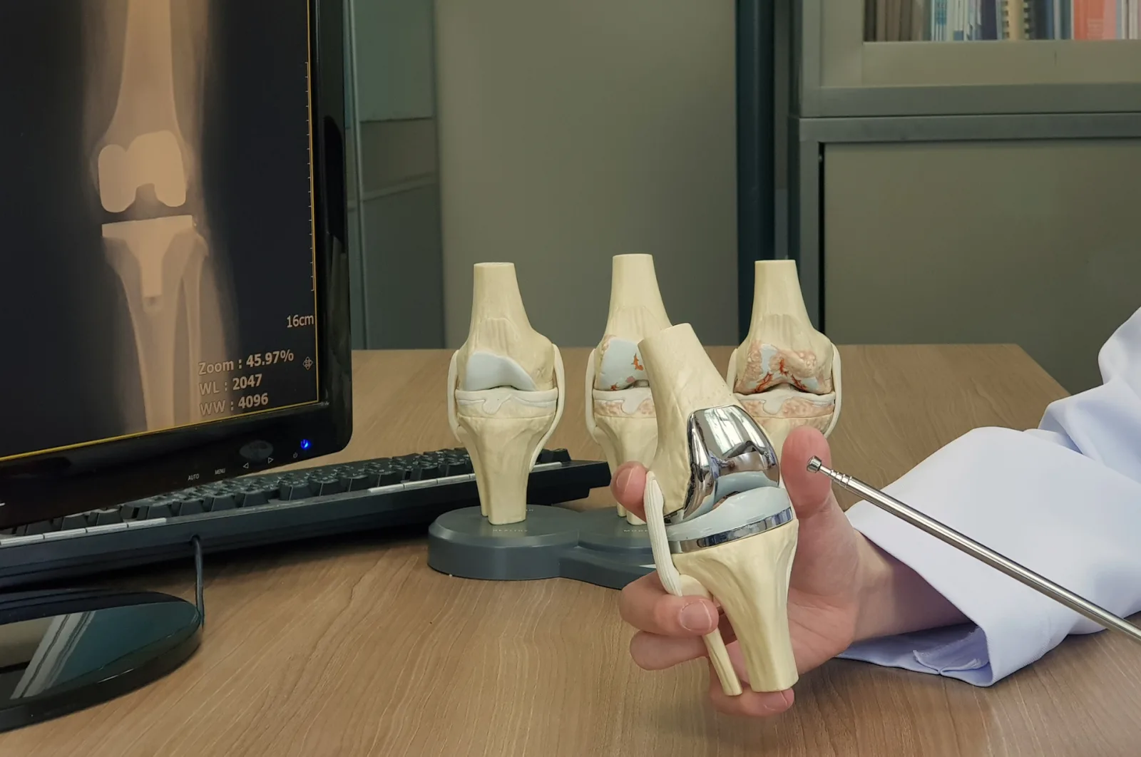 A surgeon holds a knee replacement implant model beside anatomical knee models and a knee X-ray on a monitor.