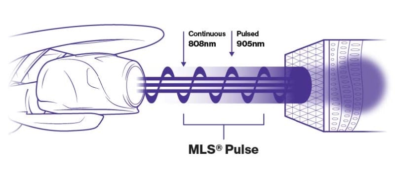Diagram of MLS laser therapy combining a continuous 808 nm and a pulsed 905 nm beam penetrating tissue.
