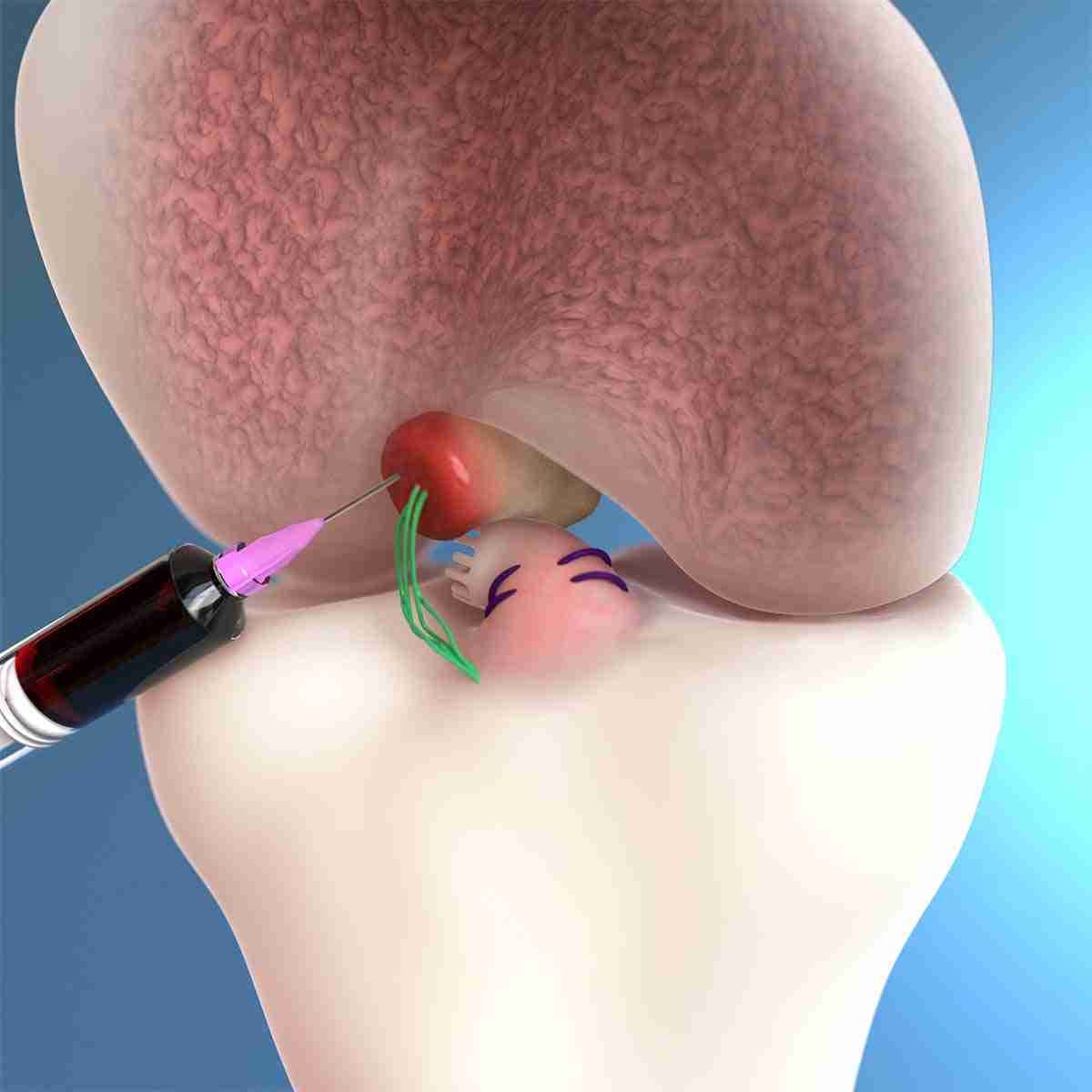 3D illustration of platelet-rich plasma from the patient's own blood being injected into a knee cartilage repair site.