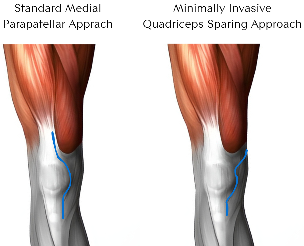 Diagram comparing the standard medial parapatellar incision with the minimally invasive quadriceps-sparing approach to the knee.