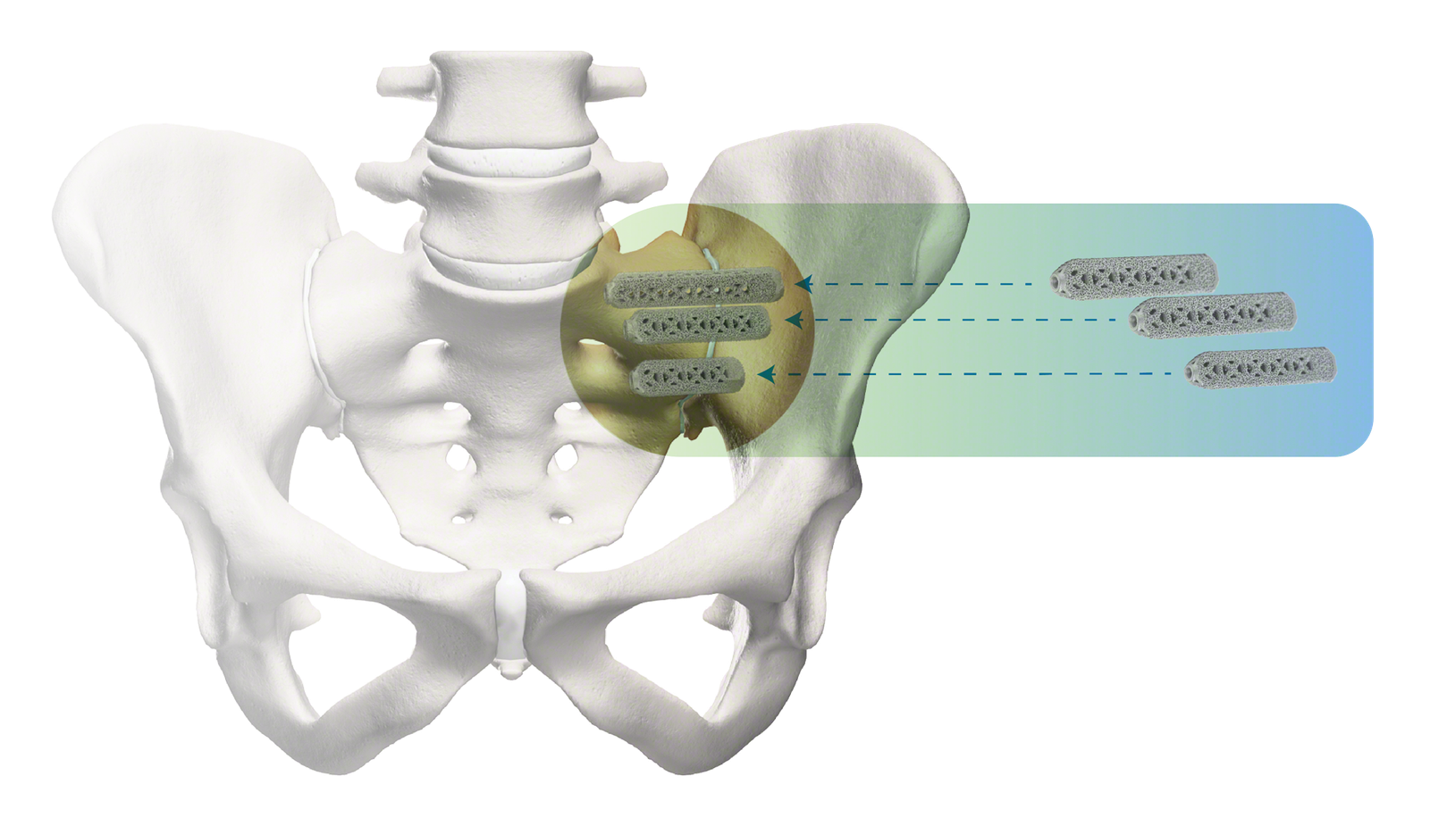 Illustration of triangular titanium implants being placed across the sacroiliac joint during minimally invasive fusion.