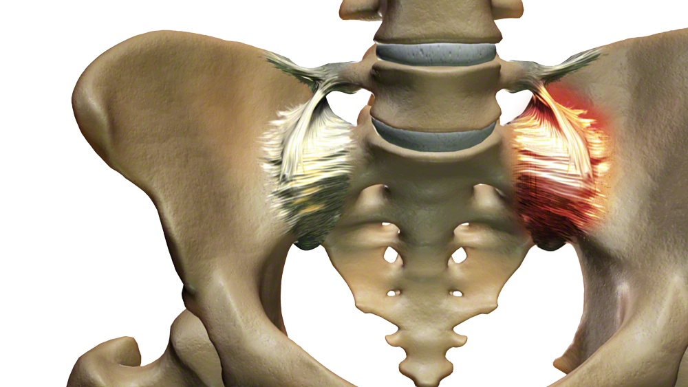 3D illustration of the pelvis with an inflamed, painful sacroiliac joint highlighted in red.
