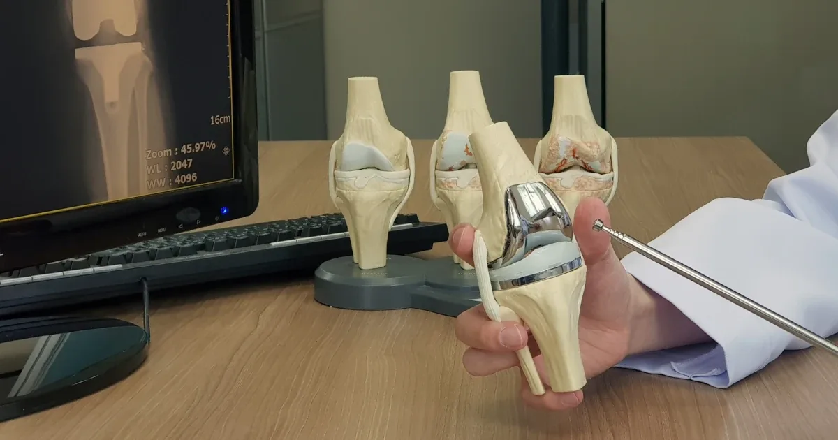 A clinician holds a total knee replacement model beside knee models showing progressive stages of osteoarthritis.