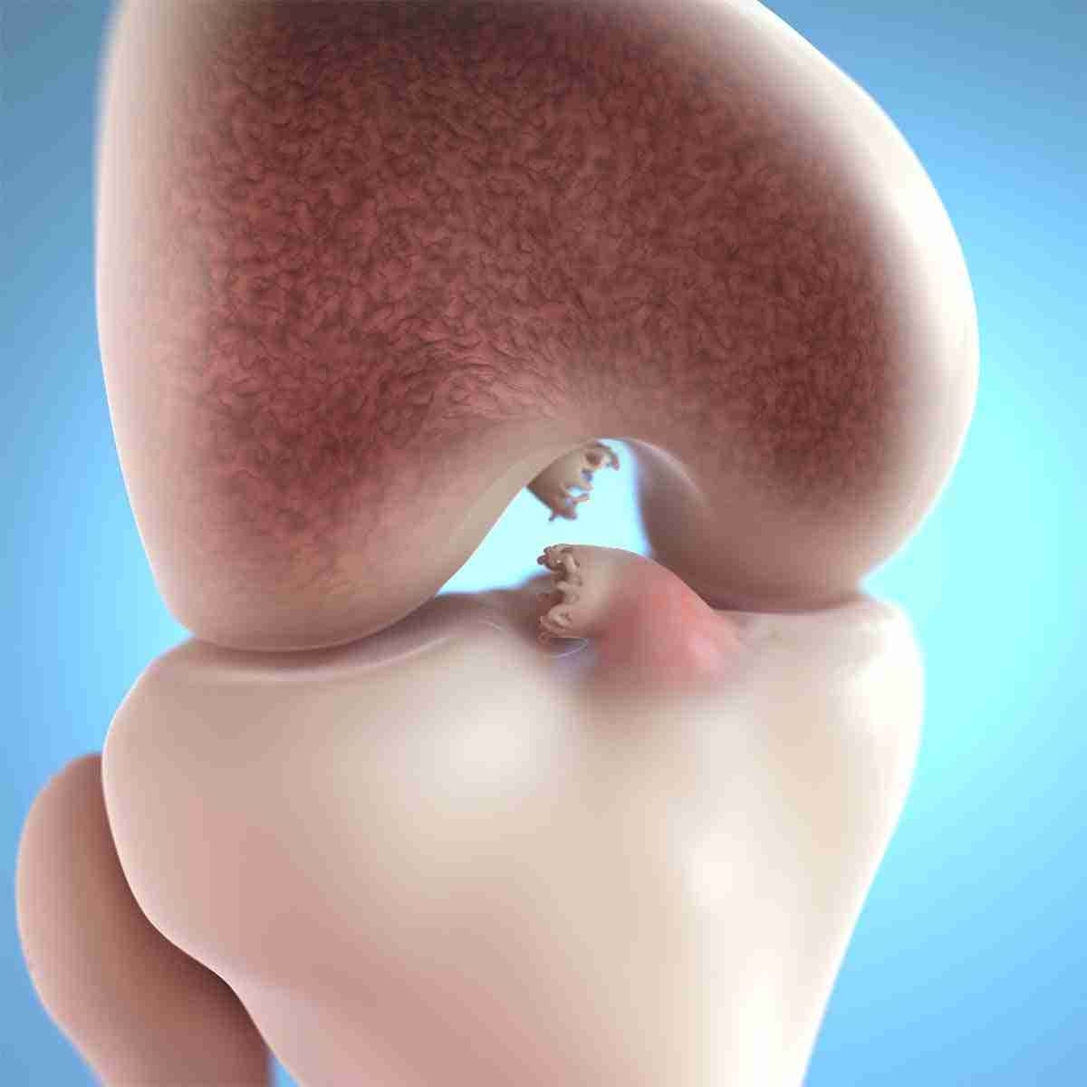 3D medical illustration of a torn anterior cruciate ligament inside the knee joint.