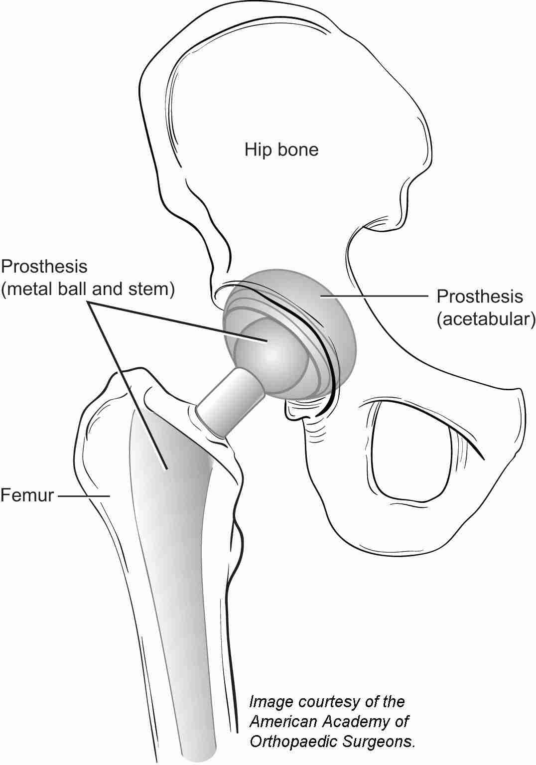 Labeled diagram of a total hip replacement showing the metal ball-and-stem prosthesis in the femur and the acetabular component in the hip bone.