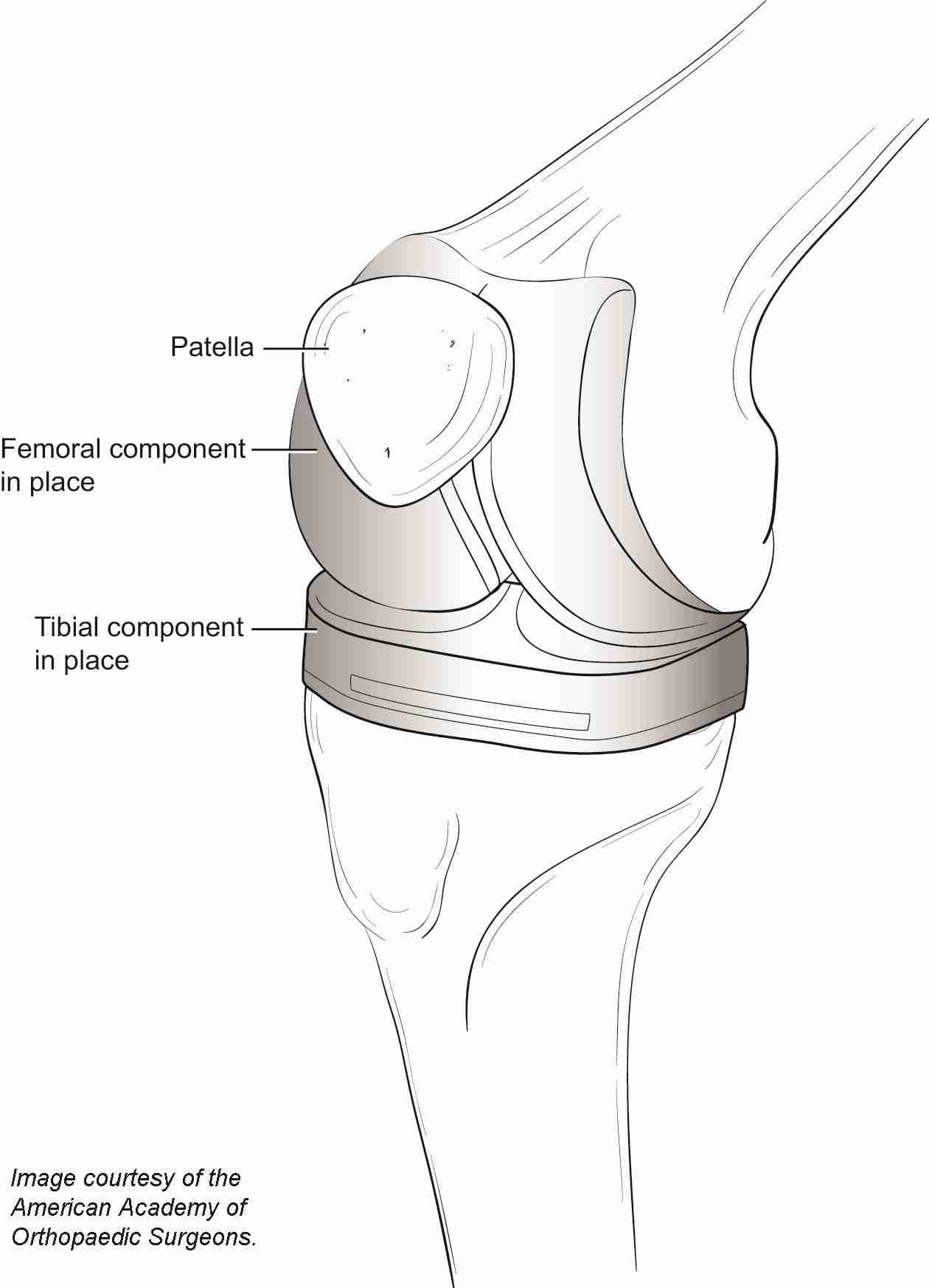 Labeled diagram of a total knee replacement showing the femoral component, tibial component, and patella in place.