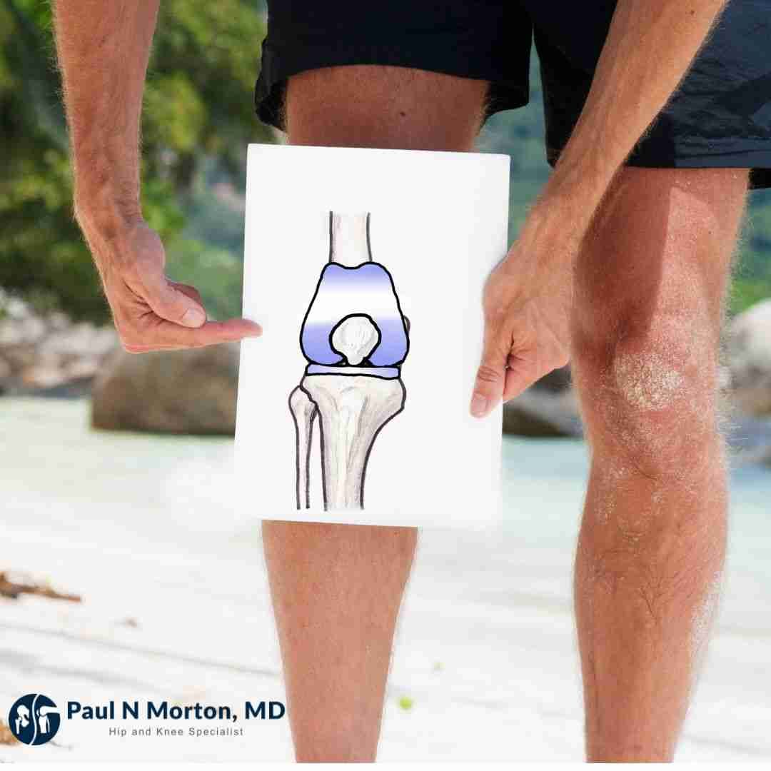 Man on a Hawai'i beach holding a knee replacement illustration in front of his knee, illustrating the question of being too young for surgery.