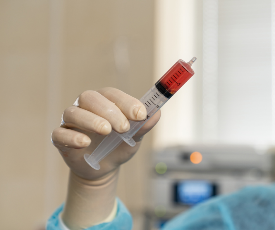 Surgeon in sterile gloves holding a syringe of freshly drawn bone marrow aspirate used for BMAC therapy.