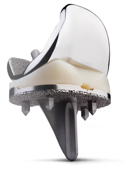 Cementless total knee replacement implant with porous titanium surfaces that let bone grow directly into the components.
