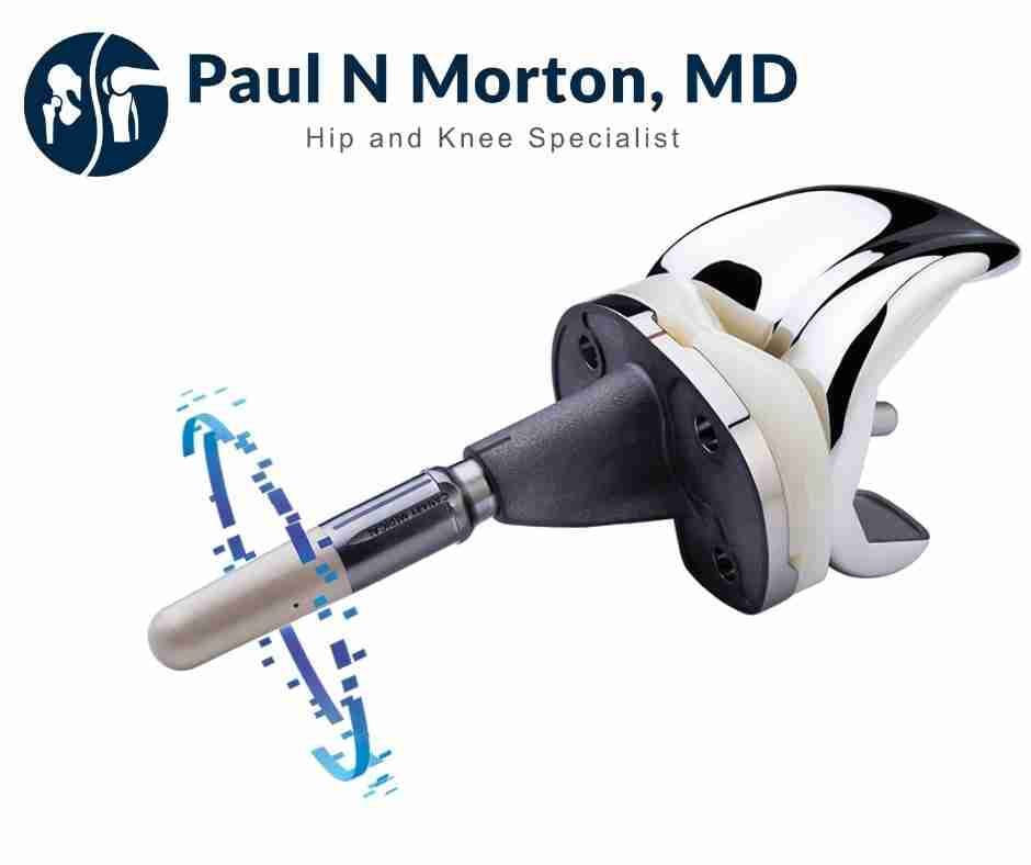 Persona IQ smart knee implant with its sensor-bearing tibial stem extension — the smart knee Dr. Paul Morton placed first in Hawai‘i, in Honolulu.