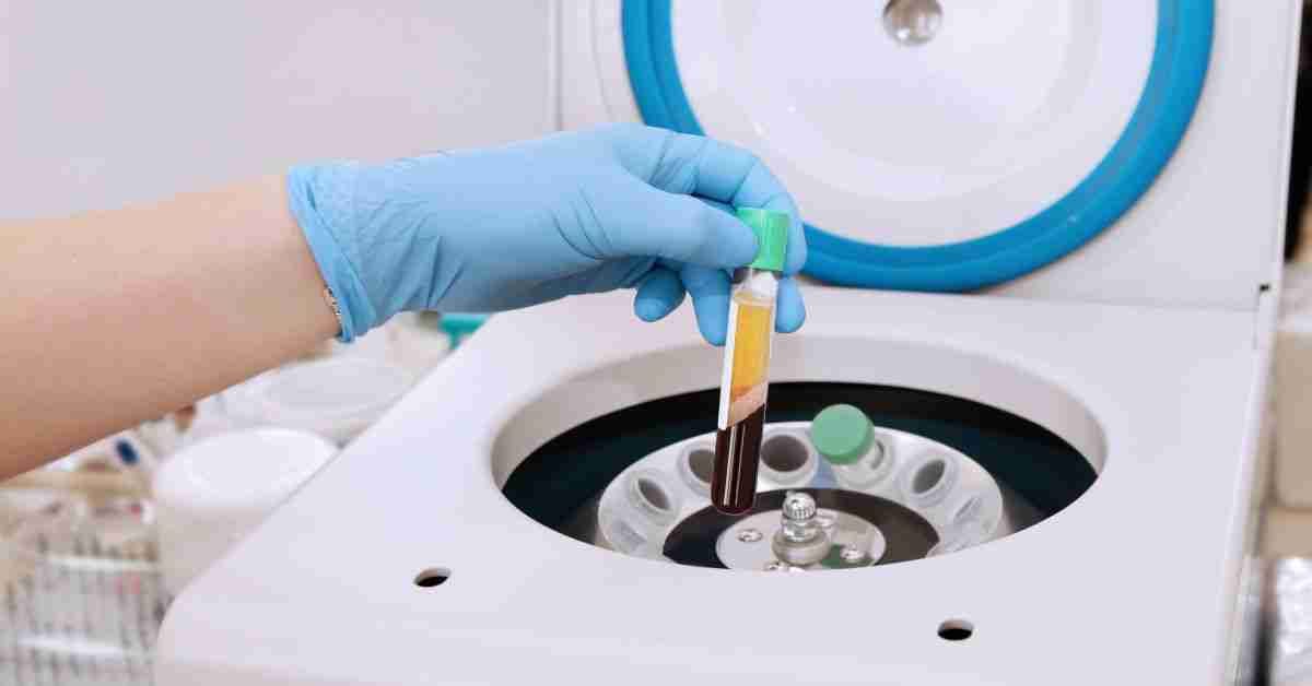 A gloved hand lifts a tube of separated platelet-rich plasma from a centrifuge during PRP preparation.