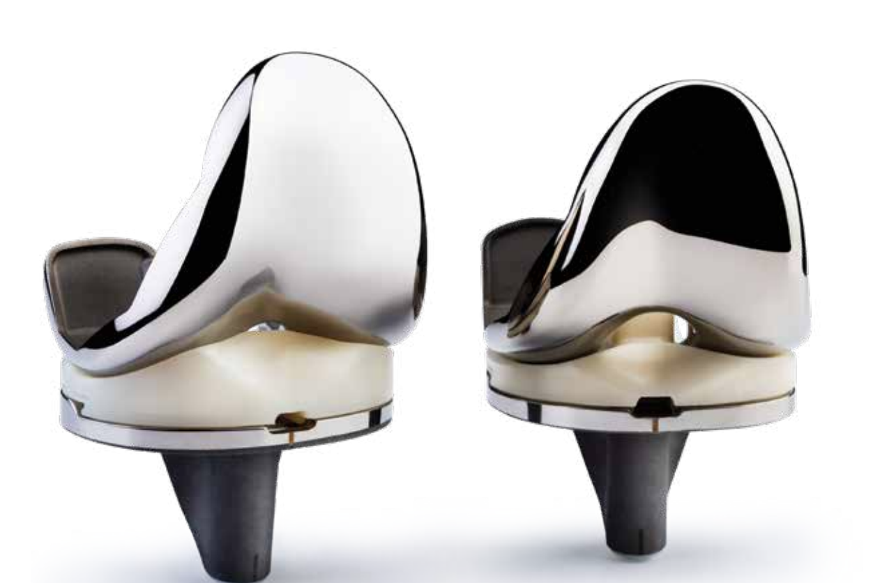 Two polished Ti-Nidium total knee implant components with tibial trays, designed for patients with metal sensitivity.
