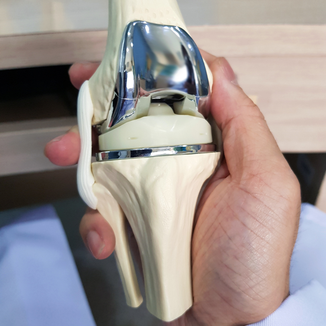 A hand holds a model of a total knee replacement showing the metal femoral component and plastic tibial insert.