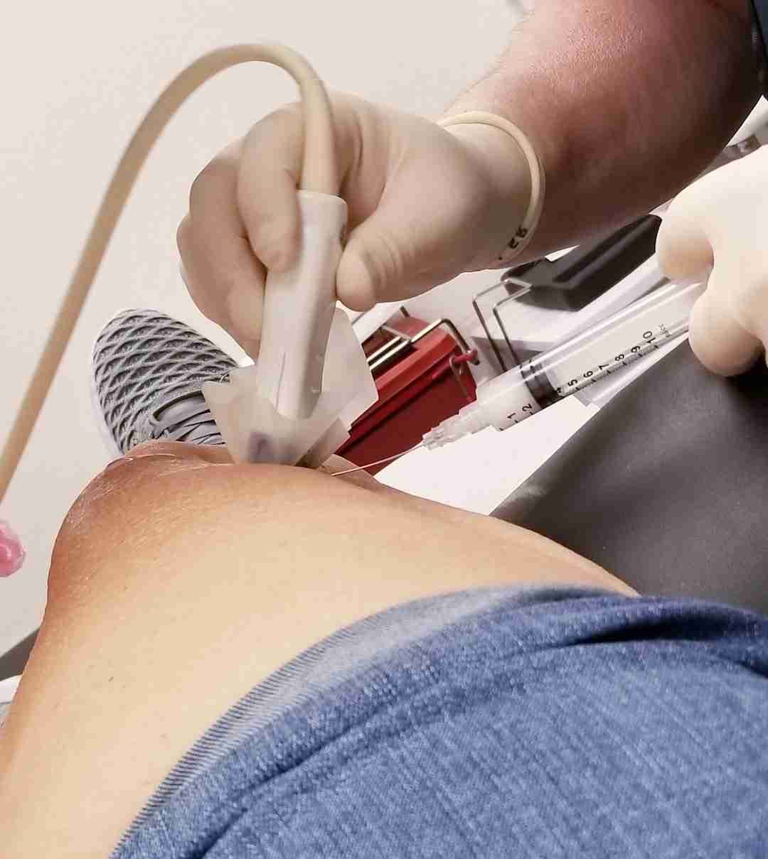 A clinician uses an ultrasound probe to guide a needle during an image-guided injection, the same technique used to place an adductor canal block.