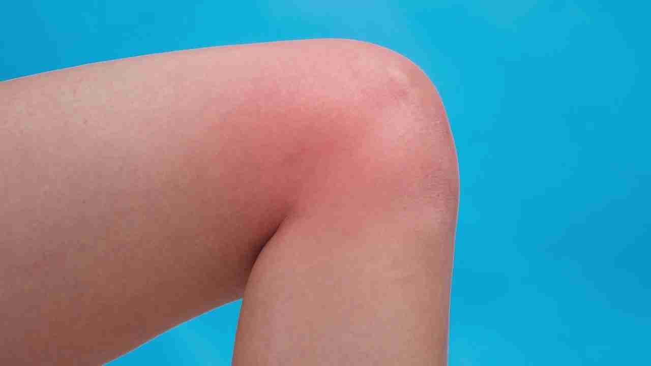 Close-up of a bent knee with visible redness and swelling against a blue background.