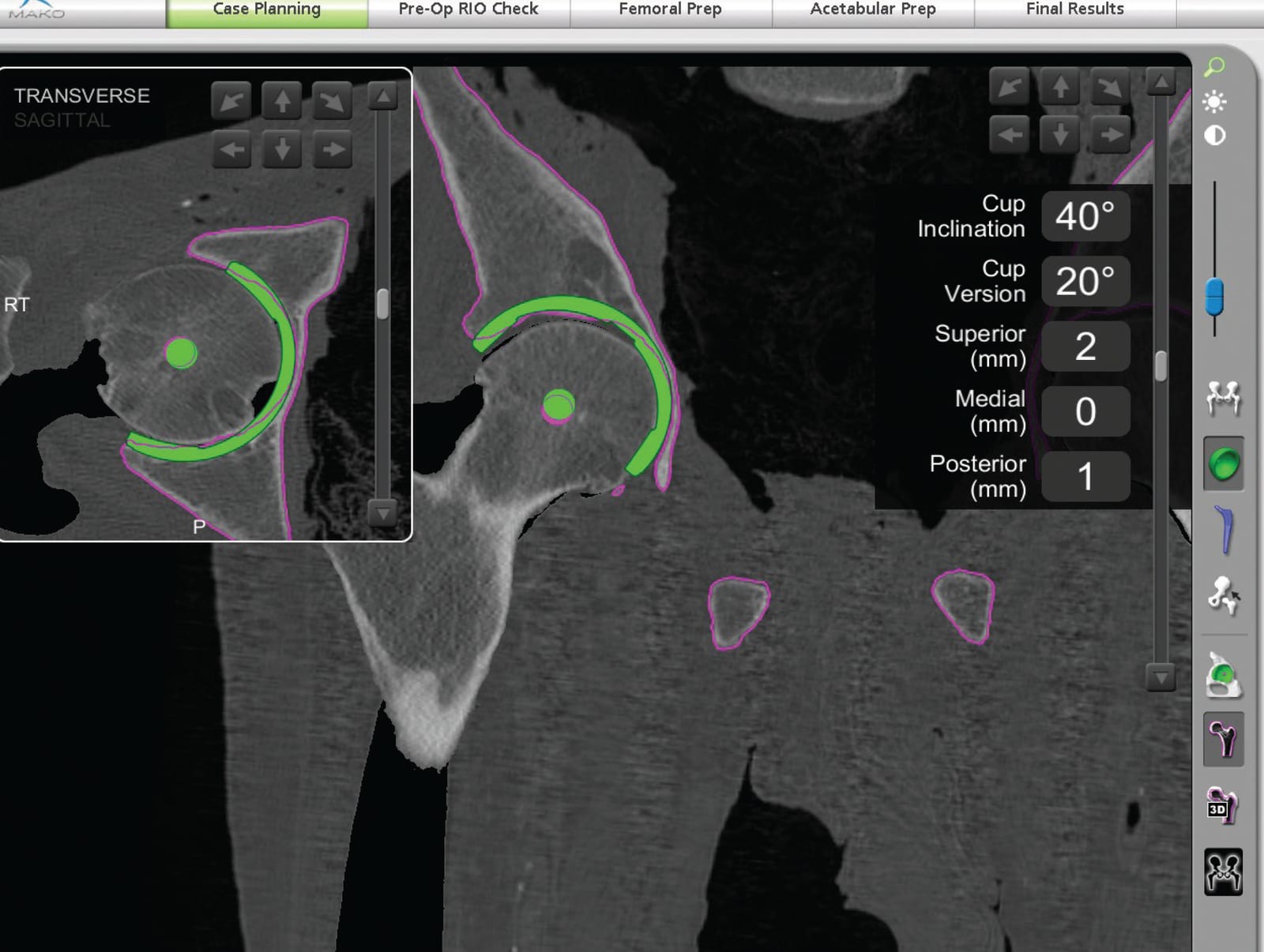 Mako case-planning screen: CT images of a hip with the planned acetabular cup drawn in green, and the cup inclination (40°) and version (20°) set before surgery.