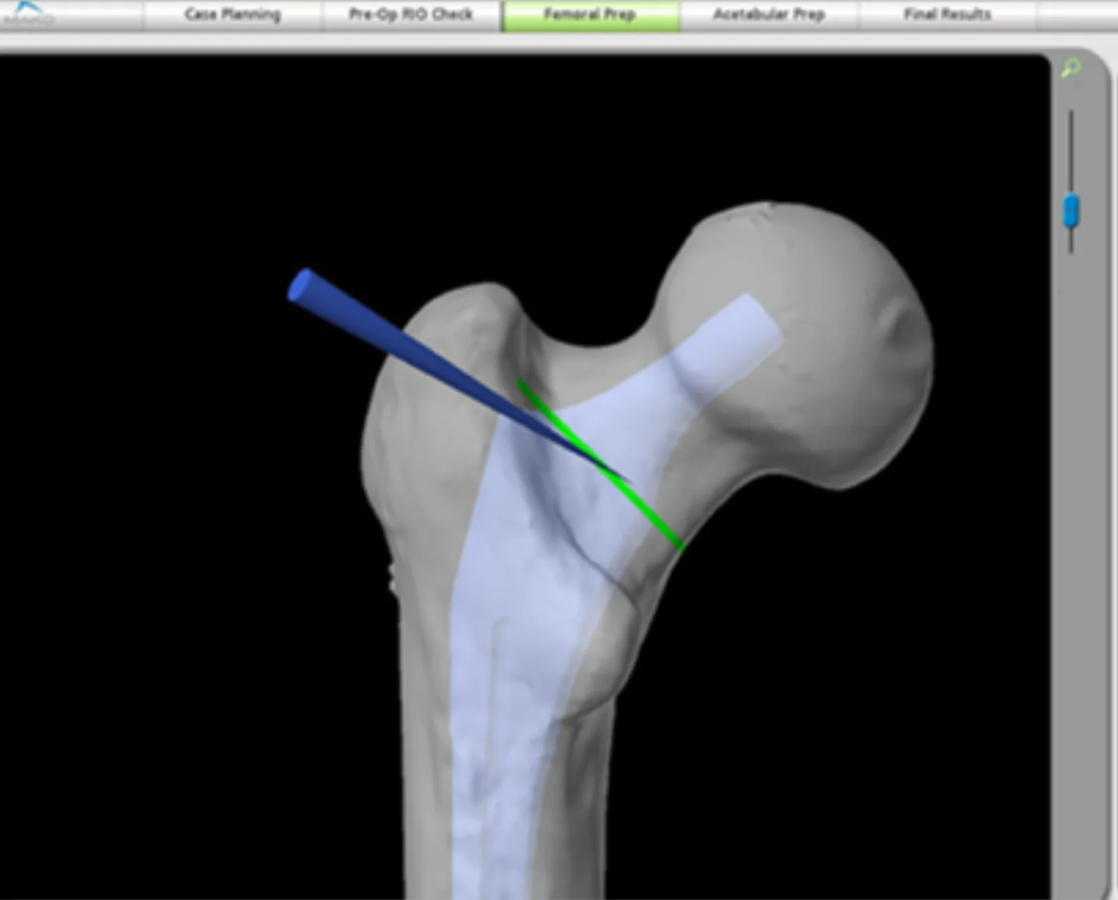 Mako Femoral Prep screen: a 3D model of the femur with the planned stem shown as a translucent overlay, a blue tracked instrument, and its green planned path.