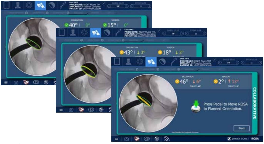 ROSA Hip navigation screens showing real-time cup inclination and version angles during robotic hip replacement.