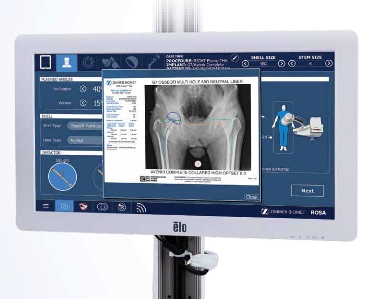 ROSA Hip software screen showing X-ray templating and implant planning for a total hip replacement.