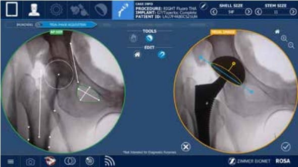 ROSA Hip robotic software screen showing fluoroscopic images used to position the cup and stem during hip replacement.
