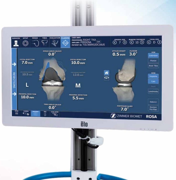 ROSA Knee robotic planning monitor displaying bone resection measurements for a total knee replacement.