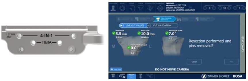 ROSA robotic knee software screen validating tibial resection values next to a 4-in-1 tibial cutting guide.