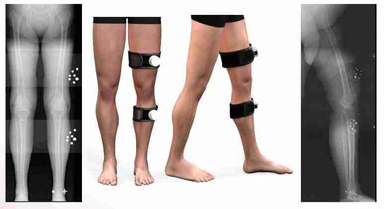 Full-leg X-rays with calibration markers and 3D leg models used for ROSA robotic knee replacement planning.