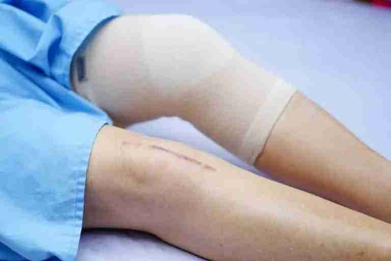Leg wrapped in a compression bandage after knee replacement, with a healed scar visible on the patient's other knee.