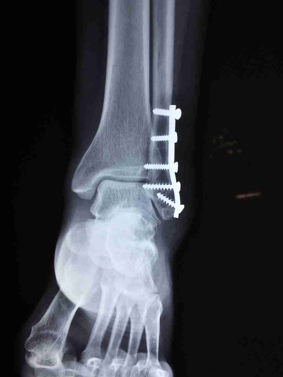 X-ray of an ankle fracture repaired with a metal fibular plate and screws, the kind of hardware sometimes removed after healing.