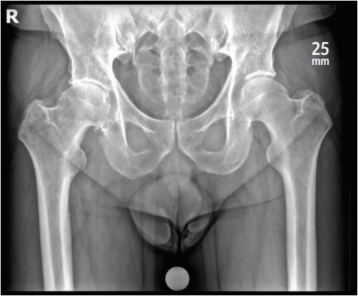 AP pelvis X-ray with a 25 mm calibration marker used for hip replacement templating.