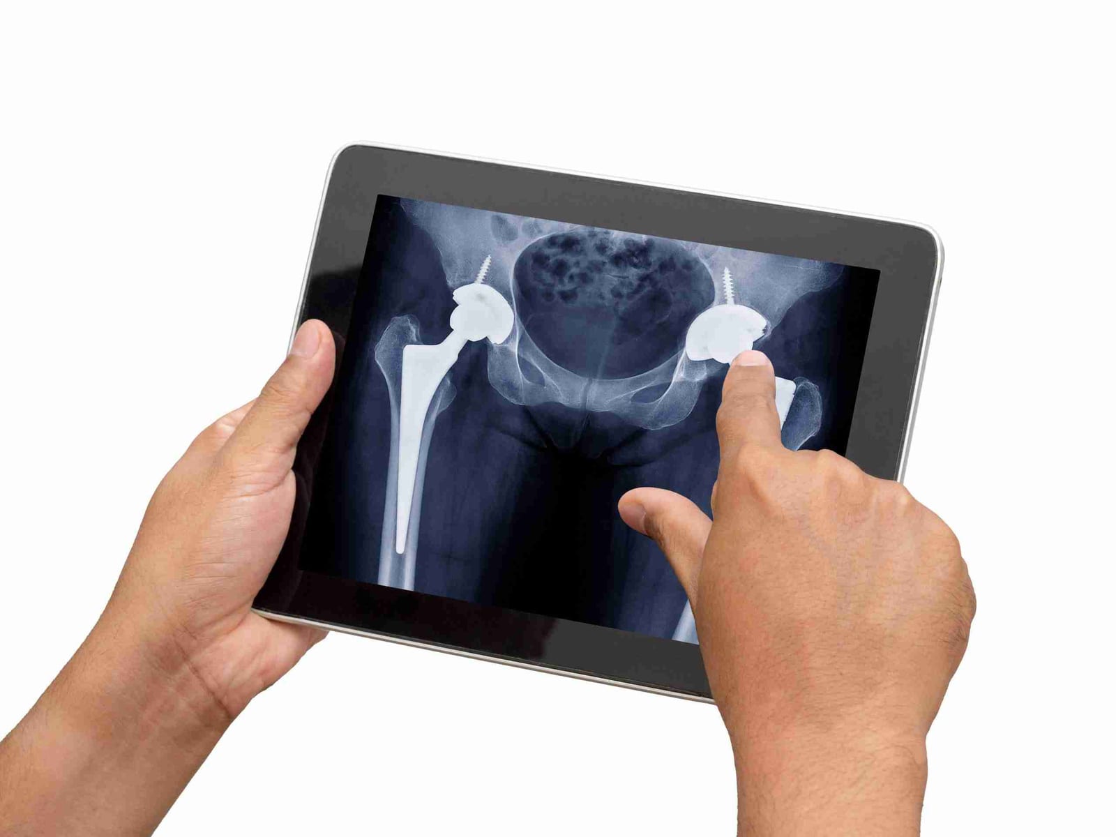 Hands hold a tablet displaying a pelvis X-ray with bilateral total hip replacements.