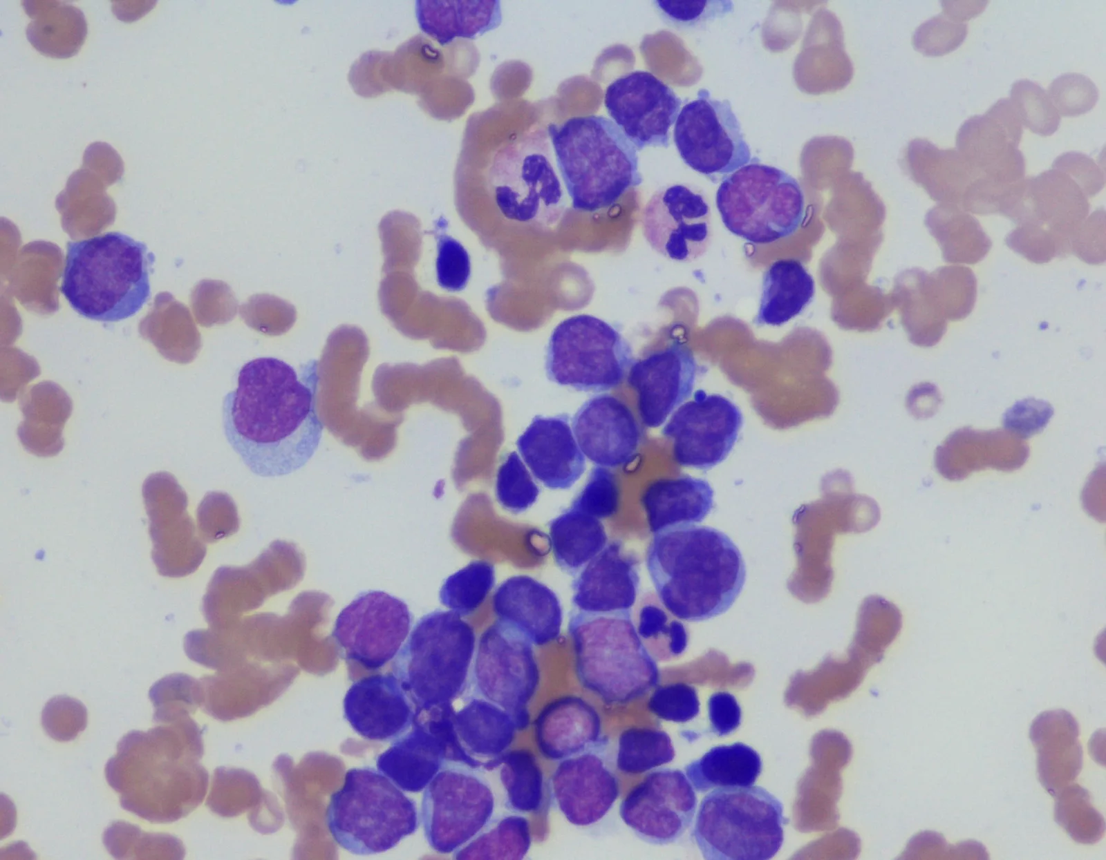 Microscope view of stained bone marrow aspirate cells like those concentrated for BMAC therapy.
