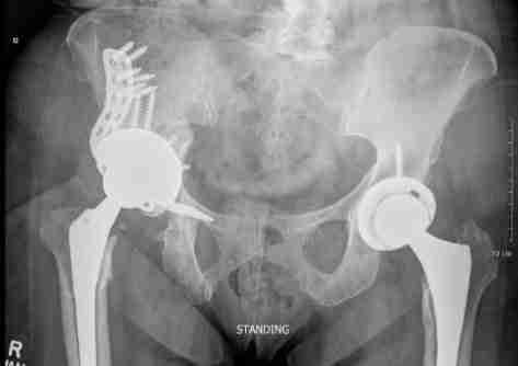 Standing pelvis X-ray showing a cup-cage reconstruction after complex revision hip replacement, with a standard hip implant on the other side.