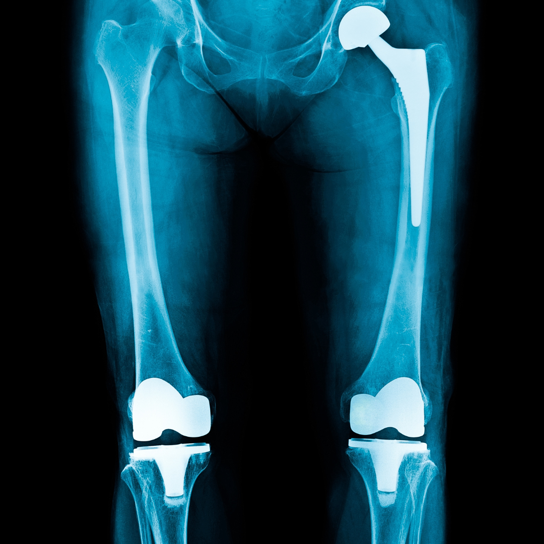 X-ray of the lower body showing a total hip replacement on one side and total knee replacements in both knees.