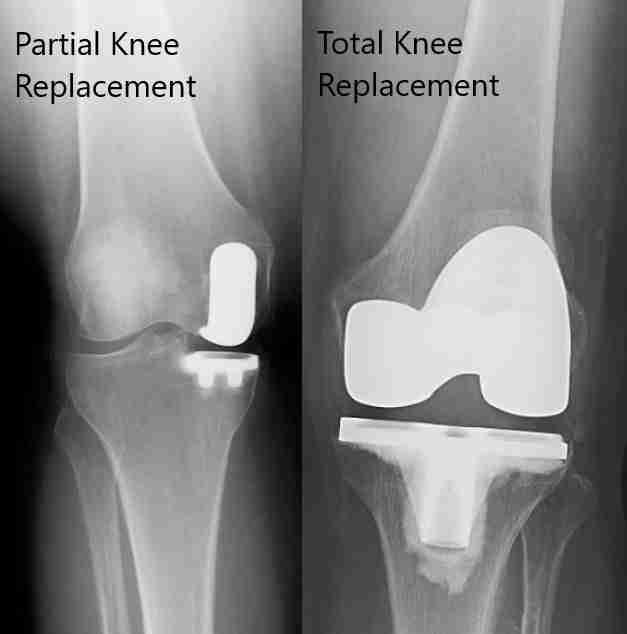 Side-by-side knee X-rays comparing a partial knee replacement implant with a total knee replacement implant.