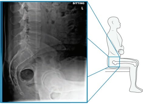 Lateral pelvis X-ray taken in the sitting position with a diagram of the patient, used to assess spinopelvic motion before hip replacement.