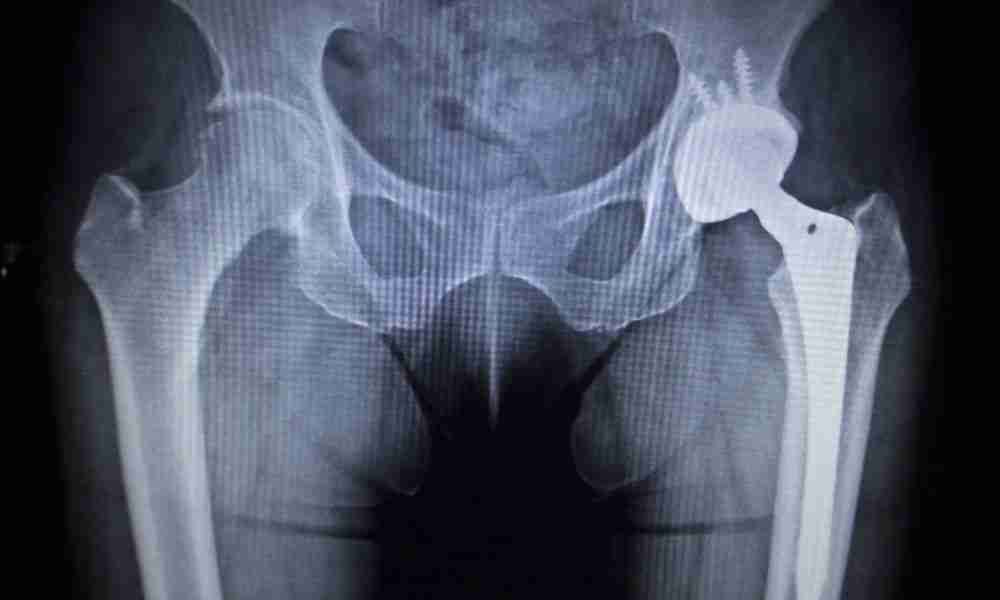 Pelvis X-ray showing a total hip replacement implant with acetabular screws on the left hip.